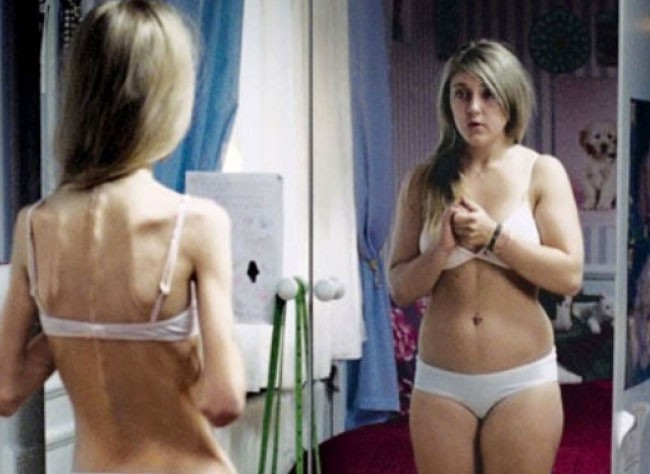 anoressia-e-bulimia